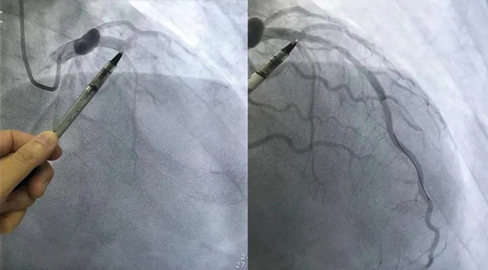 西藏大学附属阜康医院紧急救治“心肌梗死”患者