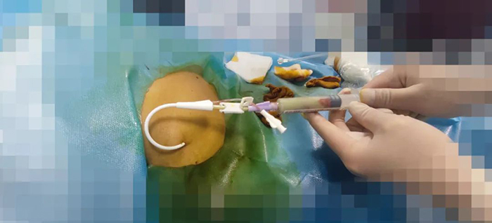西藏阜康医院成功实施一例超声引导下肝脓肿置管引流术